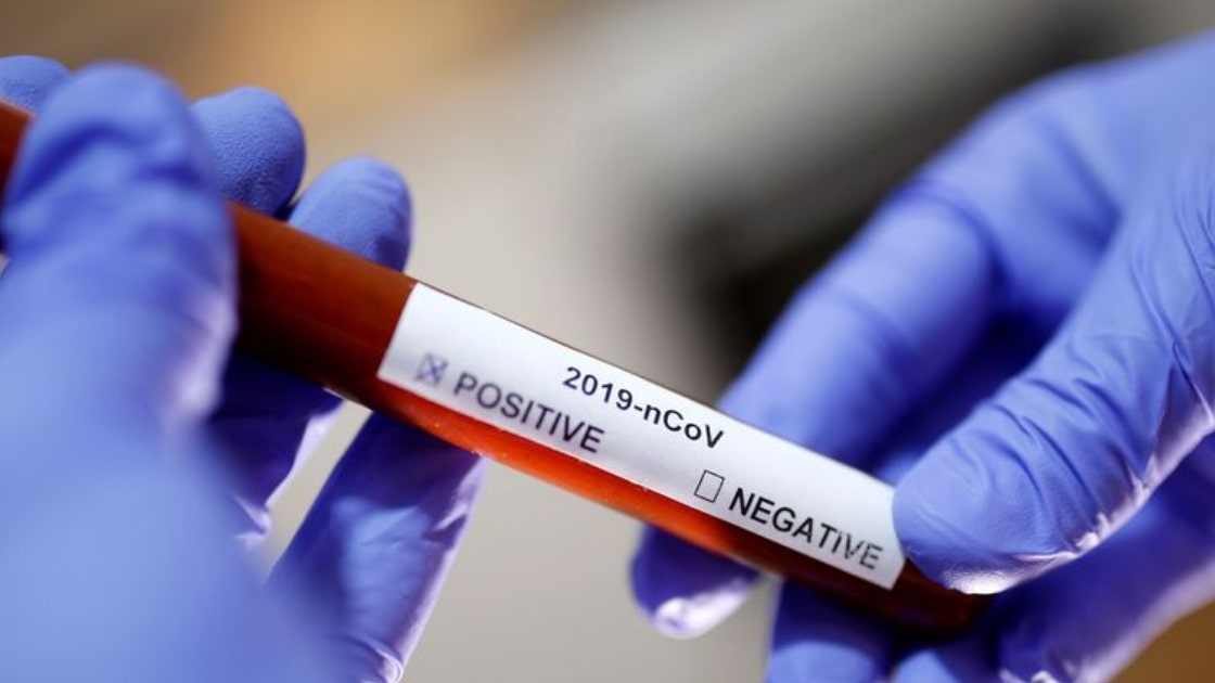 Estudo aponta anticorpos para Covid-19 em 28% dos doadores de sangue